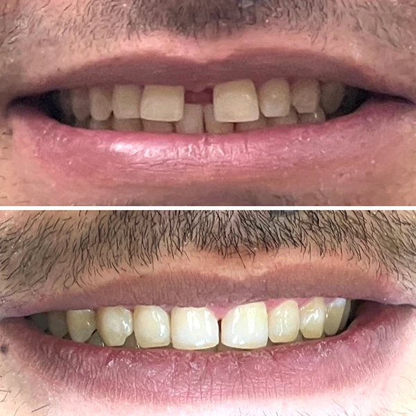 Smile transformation
