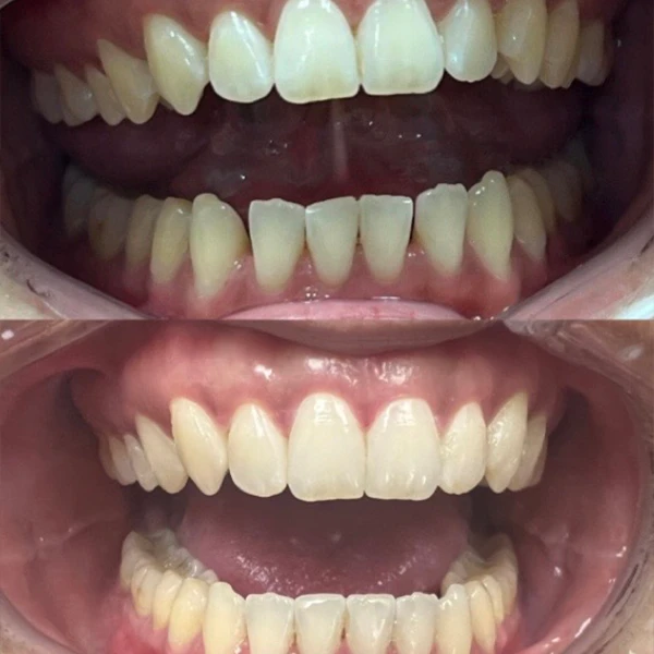 Smile transformation