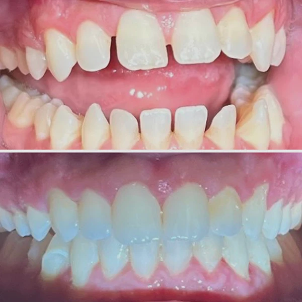 Smile transformation