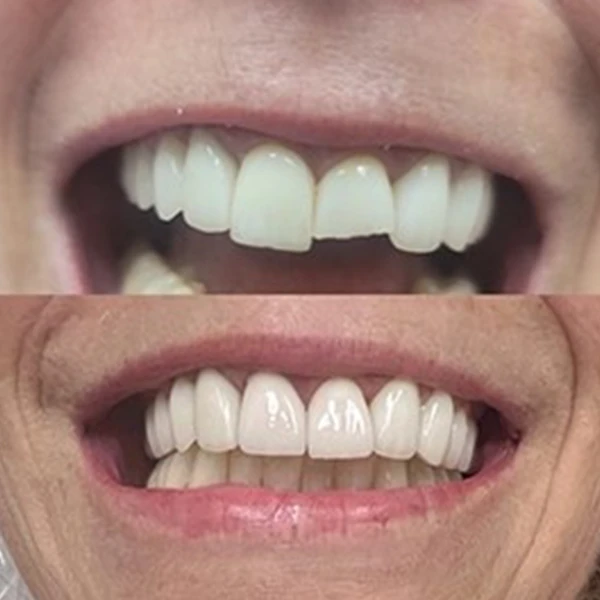 Smile transformation