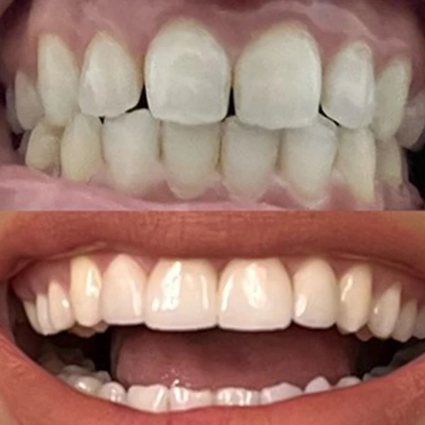 Smile transformation