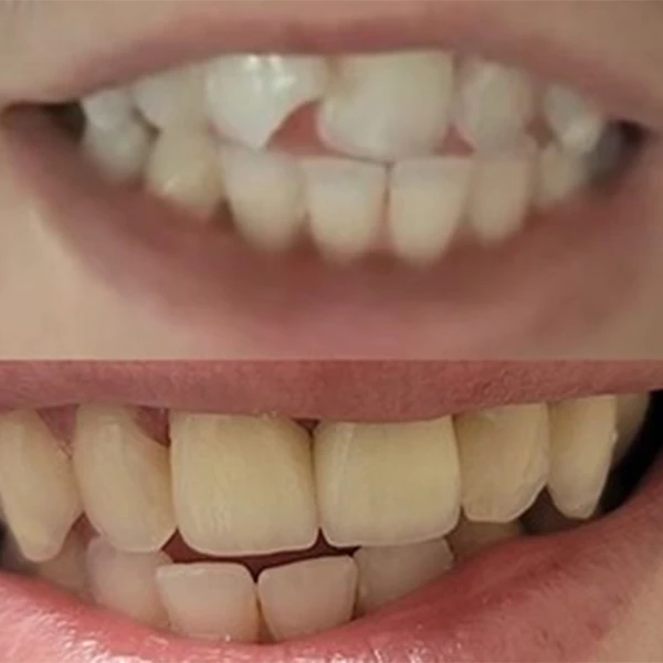 Smile transformation