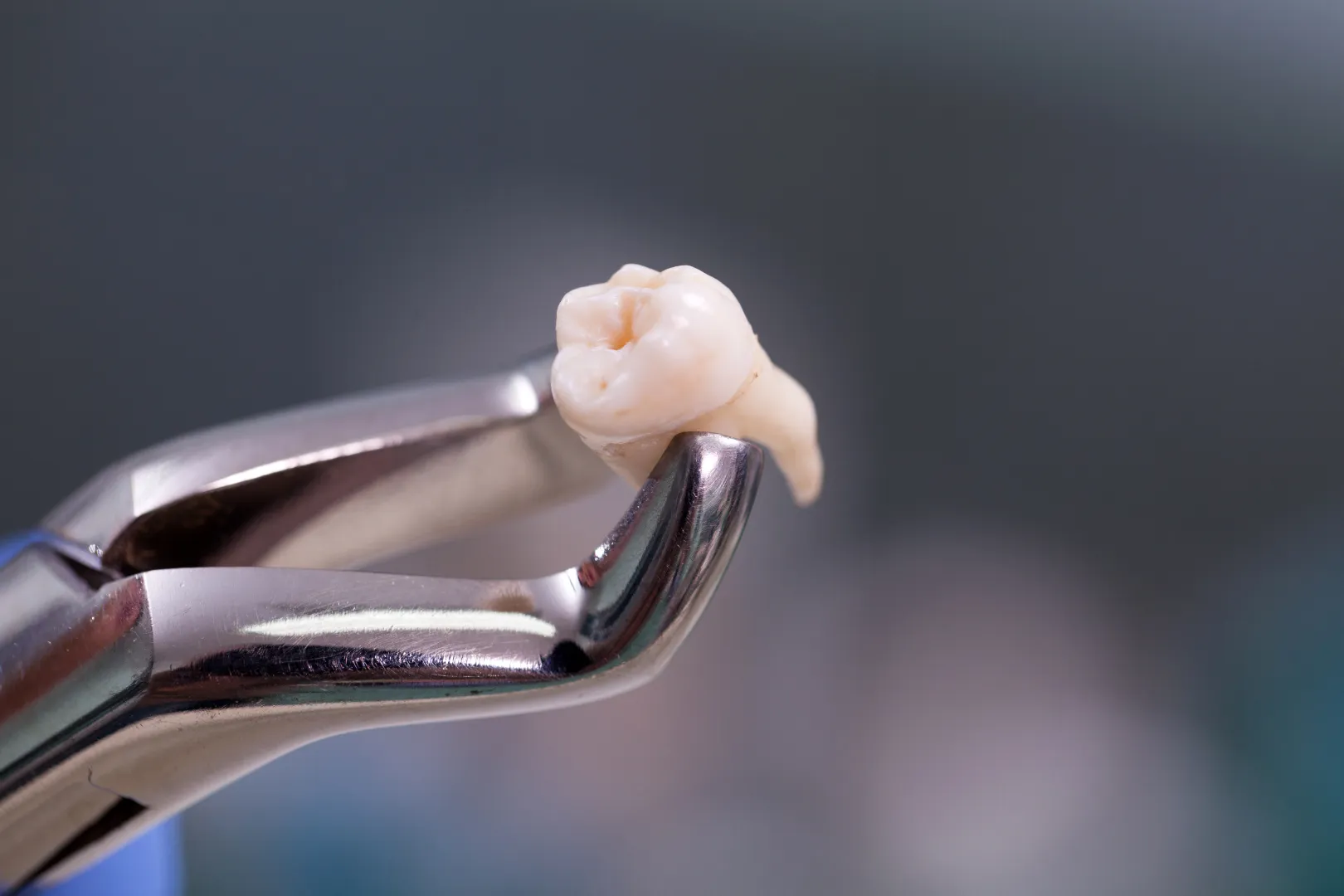 Dry Socket After Tooth Extraction