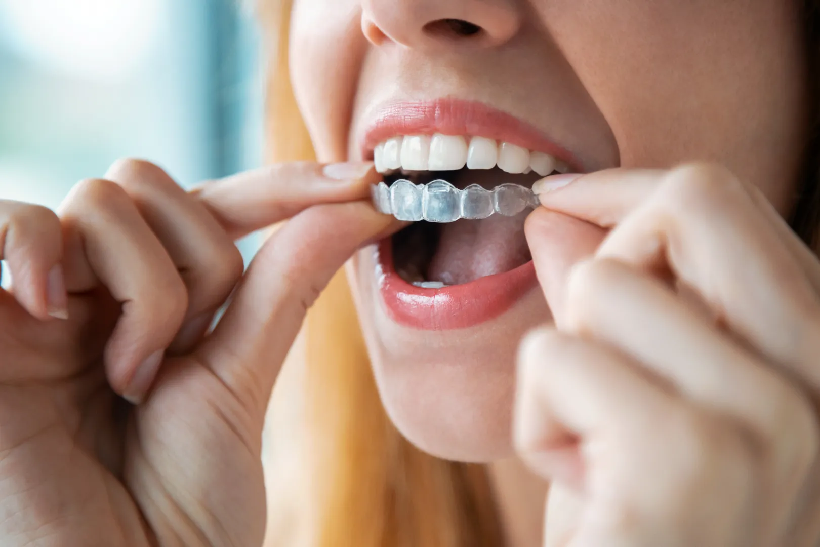 Dental Implants